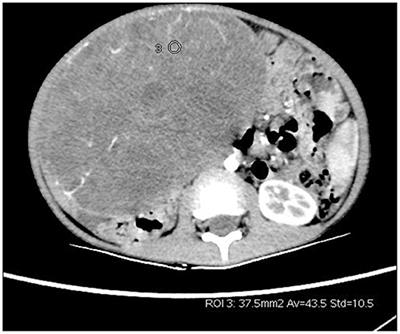 Giant Hepatic Hemolymphangioma With Peritoneal Effusion in Children: A Case Report and Literature Review